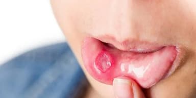 mouth ulcer