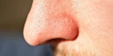 nose white heads
