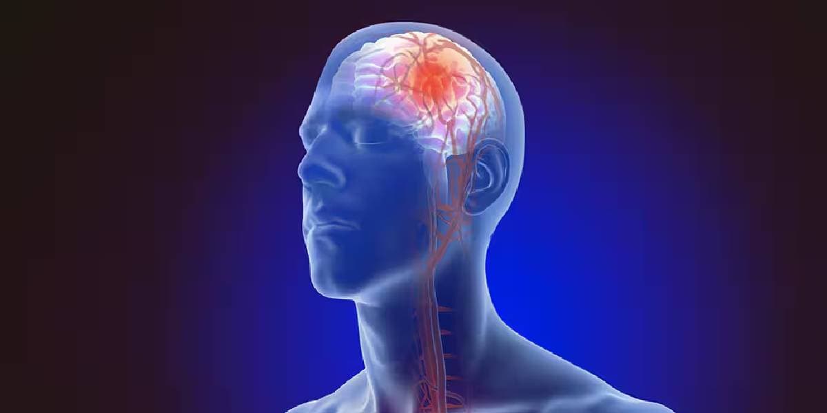 stroke