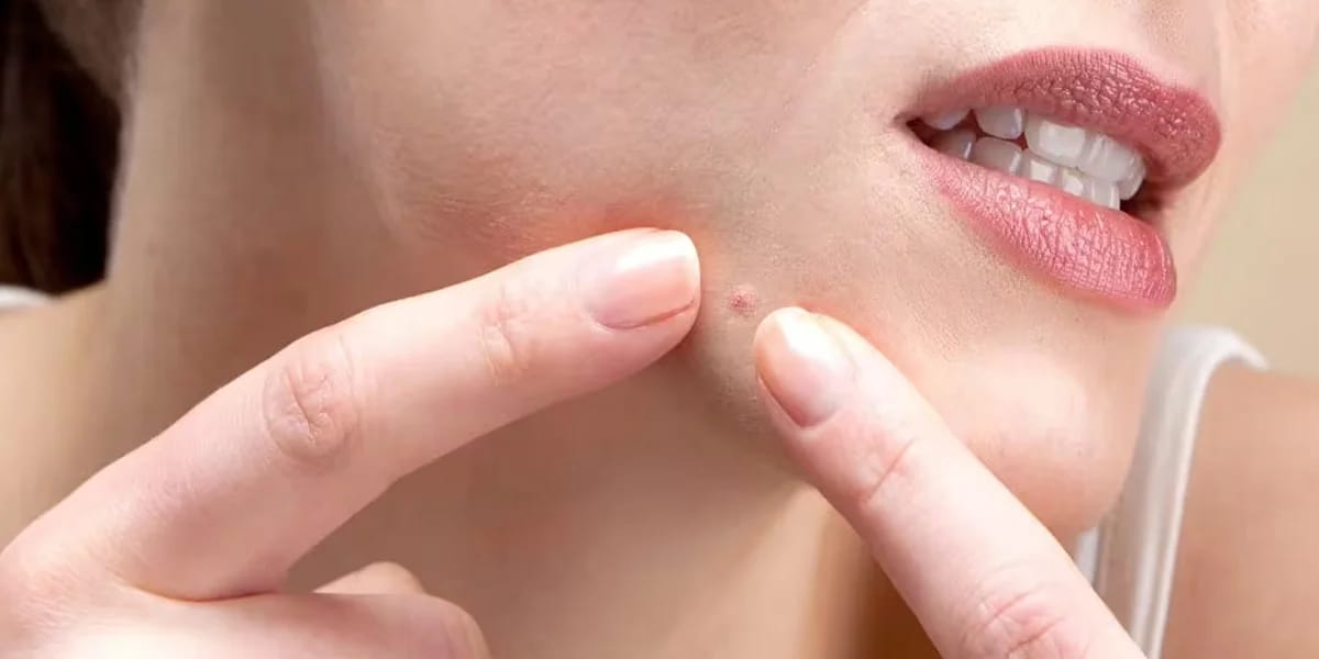 Pimple