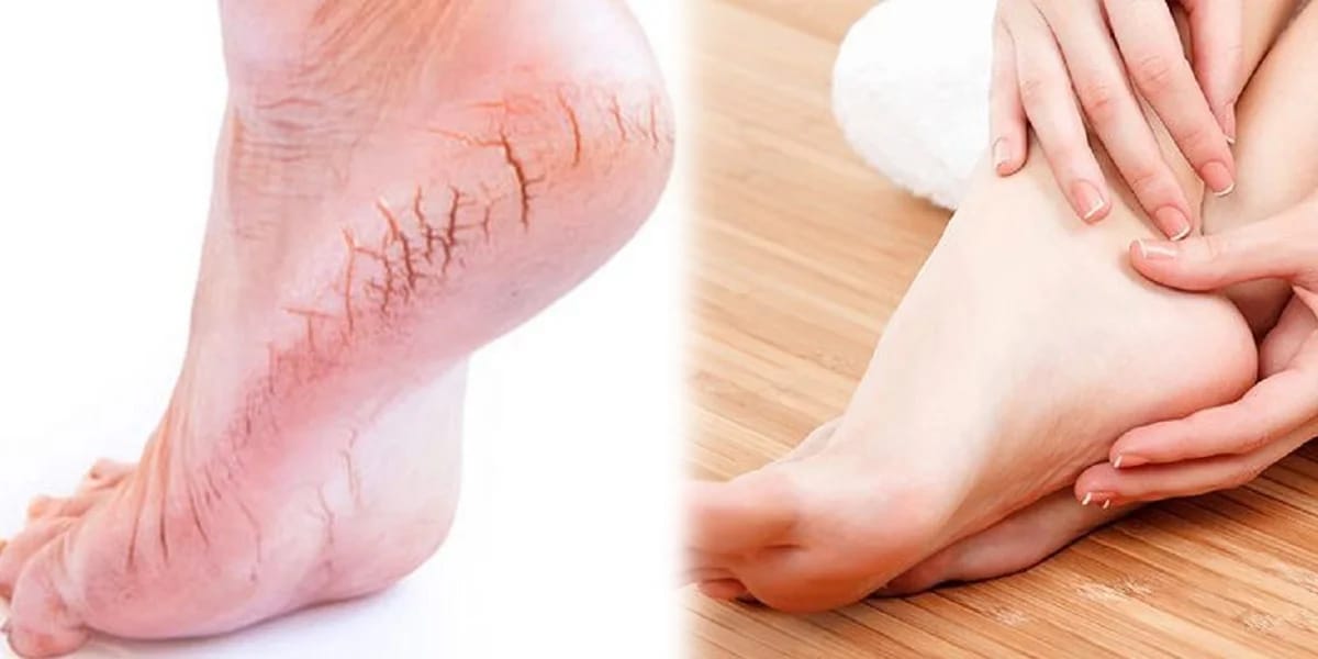Foot broken