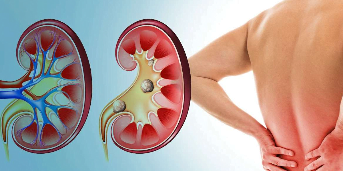 Kidney stones