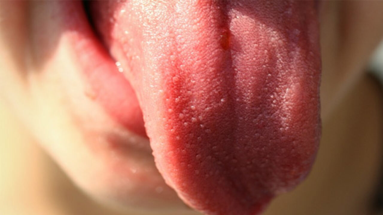 Burning tongue