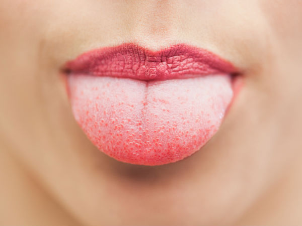 Burning tongue