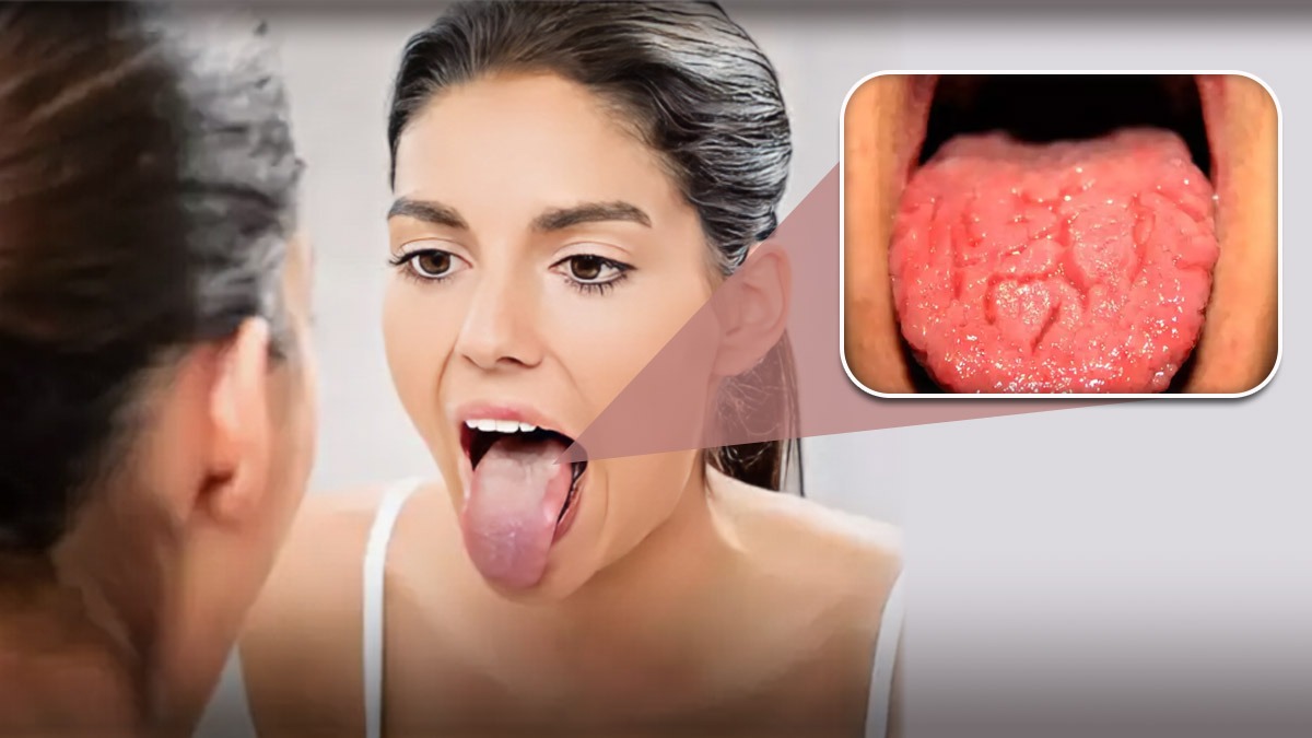 Burning tongue