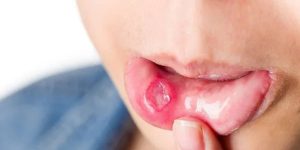 mouth ulcer