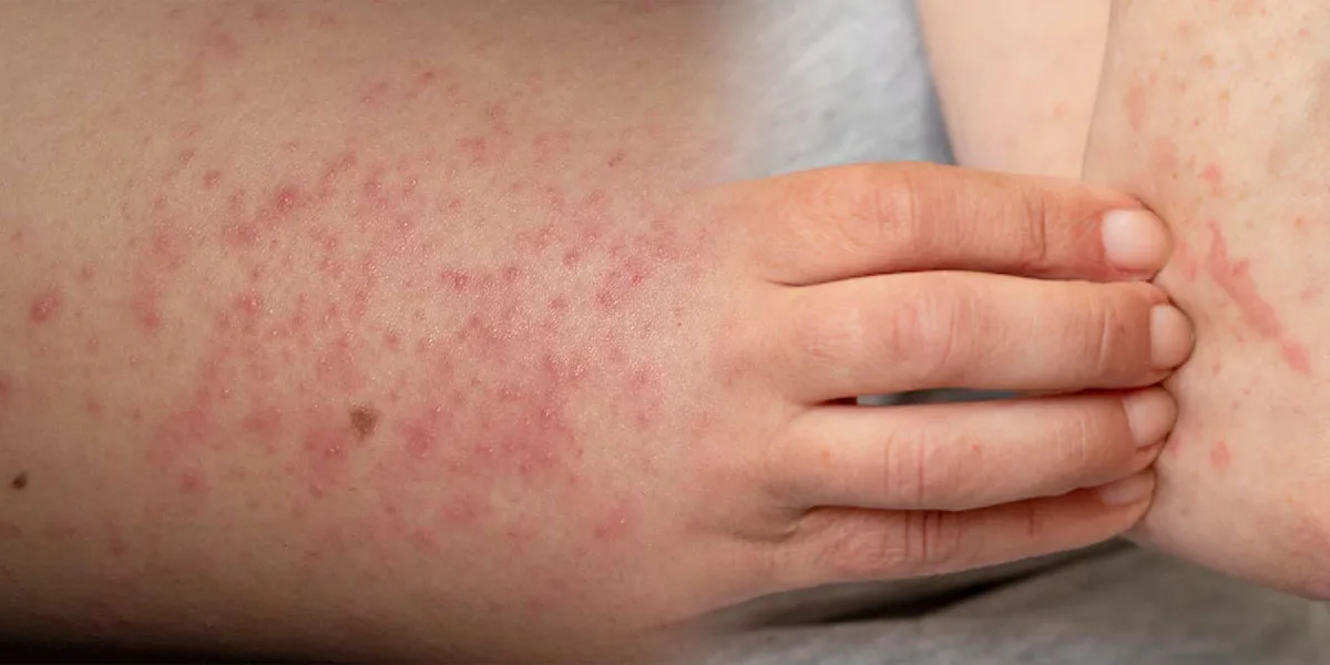Allergy