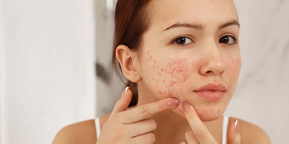 Pimples