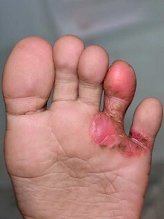 cropped-Tinea-pedis-2.jpg