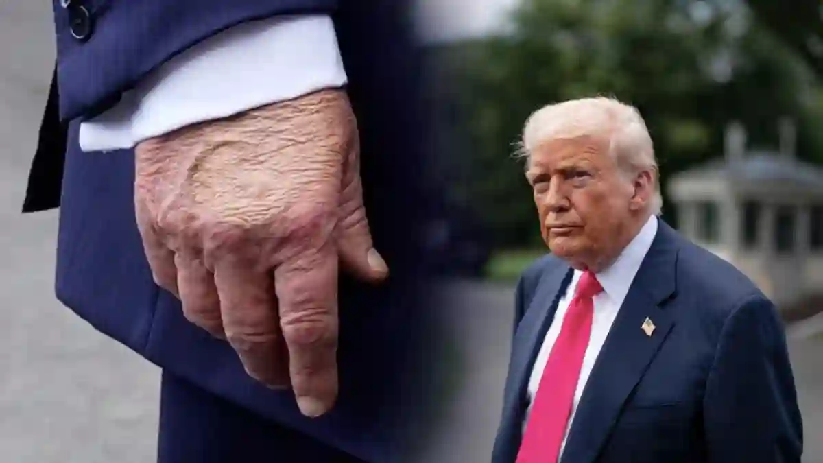 Chronic Venous Insufficiency TRUMP